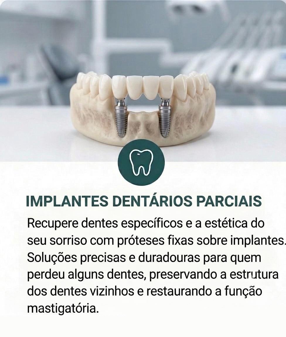 Implantes Dentários Parciais